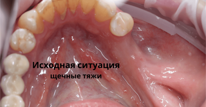 Пластика десны в области имплантатов (Давидюк И.И.) - До